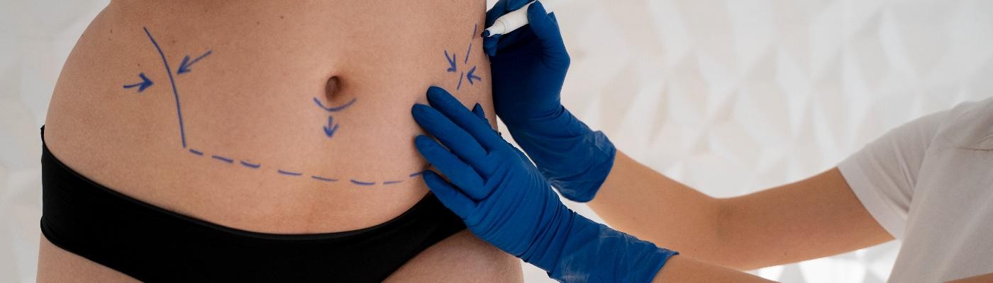 Mommy makeover: al quirófano tras el embarazo