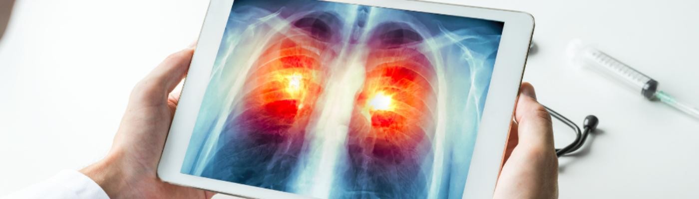 Los neumólogos no comparten el rechazo de Sanidad al cribado de cáncer de pulmón
