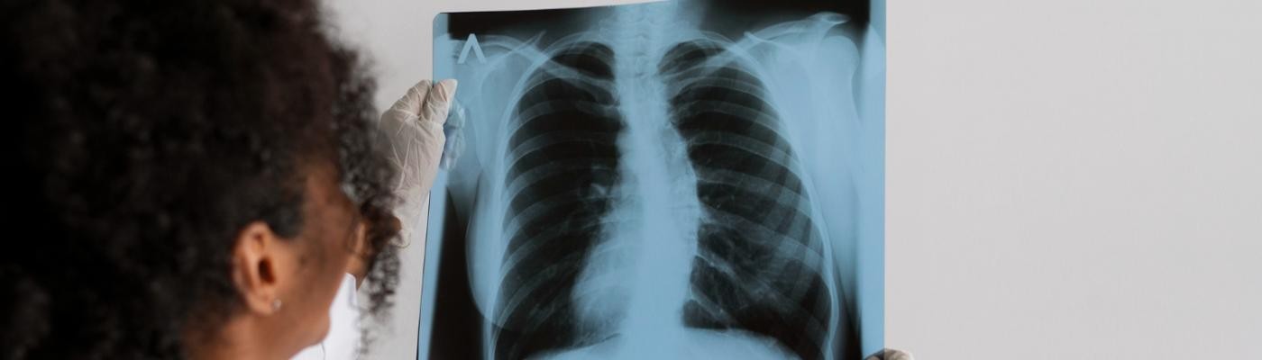 Análisis de la tuberculosis: 7.000 muertes adicionales en Europa durante la Covid