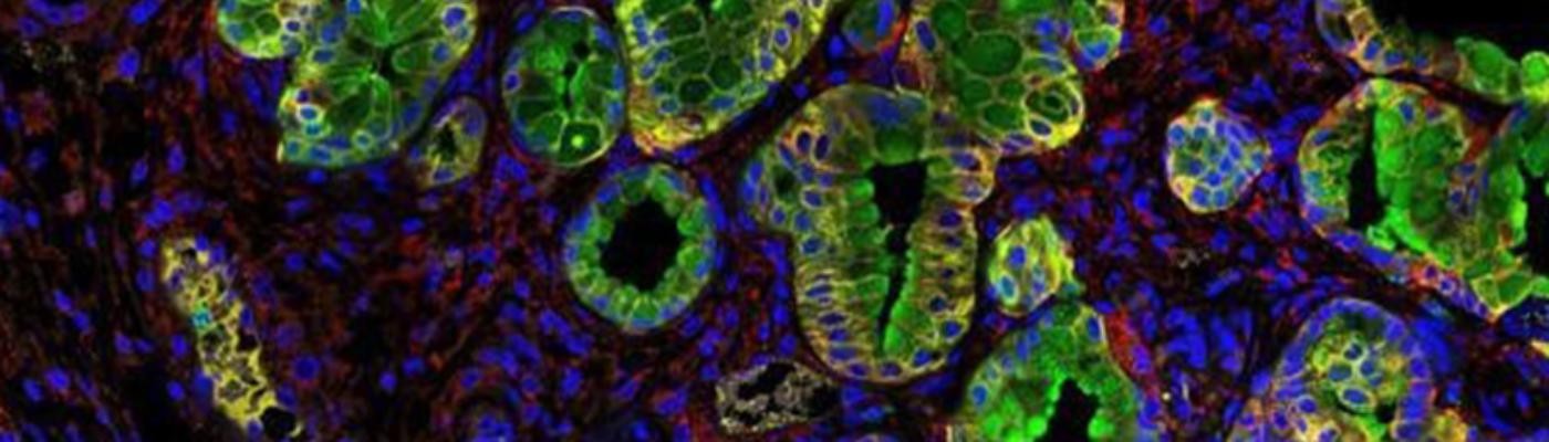 Investigadores del CSIC descubren una nueva diana terapéutica contra el cáncer de páncreas
