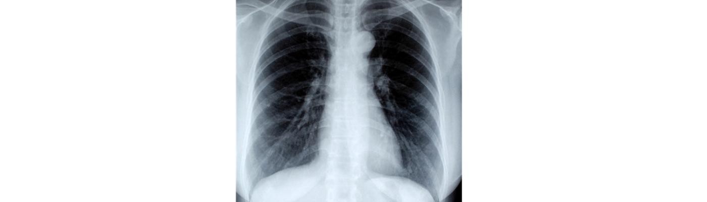 Resultados positivos del inhibidor lorlatinib en pacientes de cáncer de pulmón no microcítico