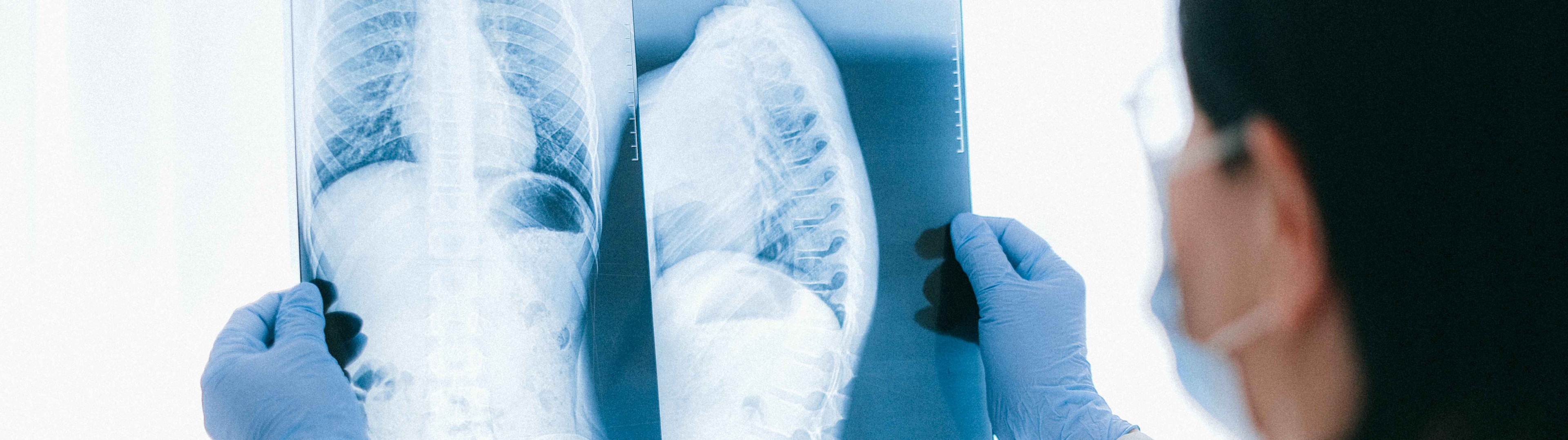 Osteogénesis imperfecta: cuando los huesos se rompen con sólo mirarlos