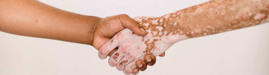 nuevos-avances-para-tratar-el-vitiligo