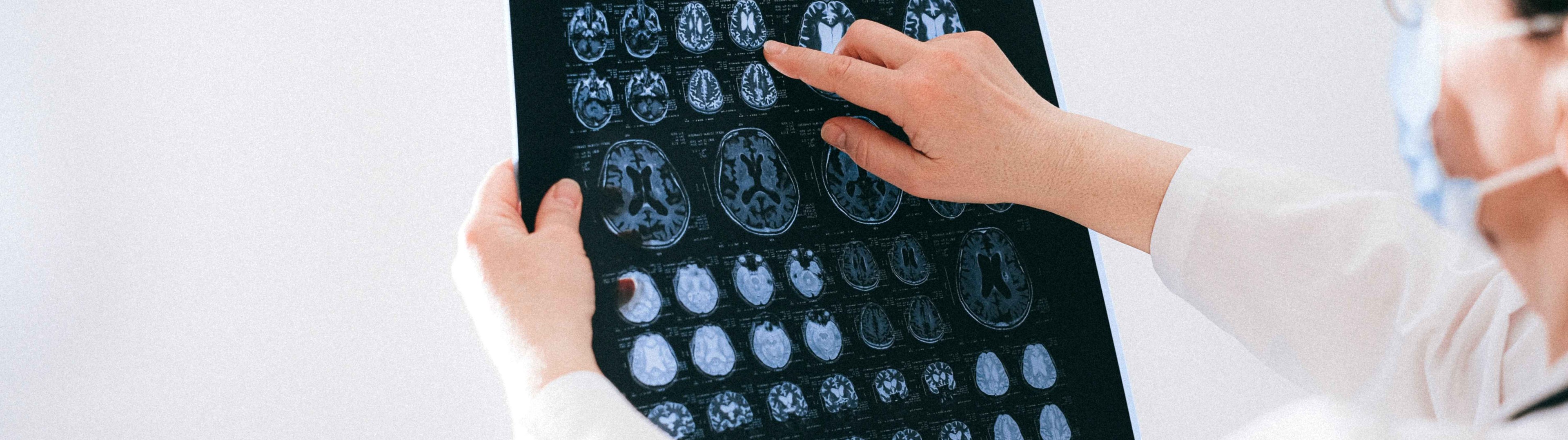 Más cerca de ralentizar el deterioro cerebral en la Enfermedad de Alzheimer