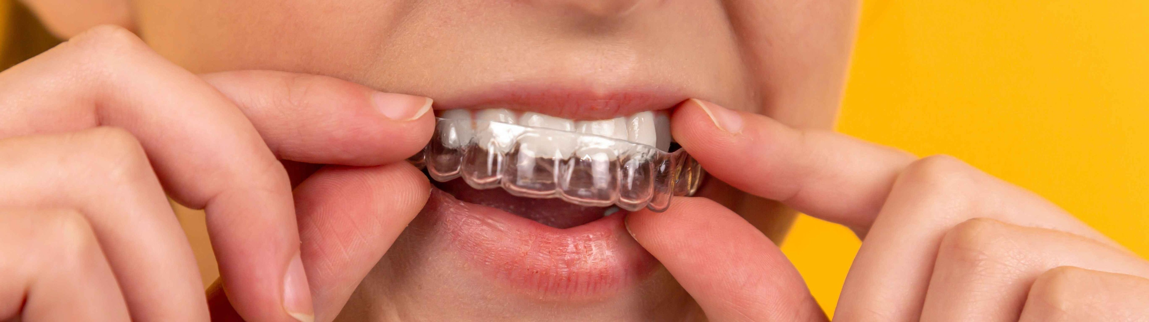 Riesgos de comprar online los alineadores dentales invisibles