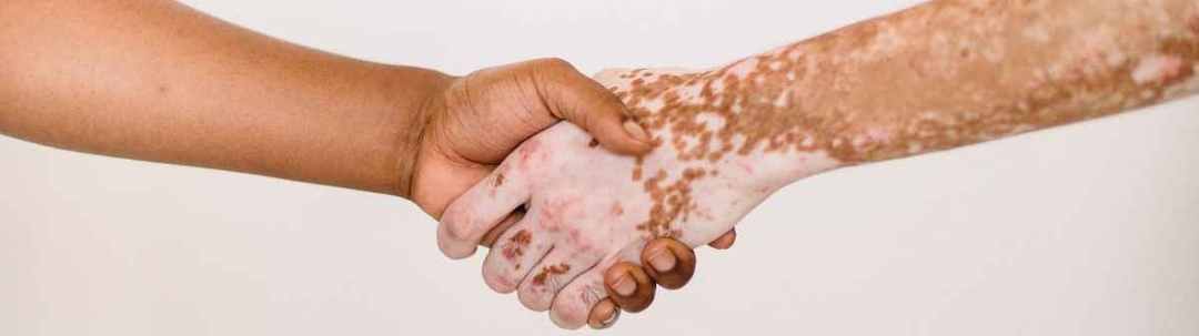 una-crema-ayuda-a-controlar-la-despigmentacion-de-la-piel-causada-por-los-efectos-del-vitiligo