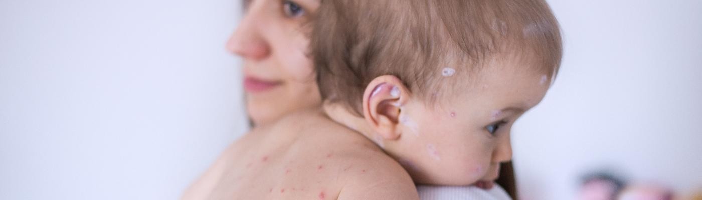 Millones de niños en riesgo en todo el mundo por el sarampión