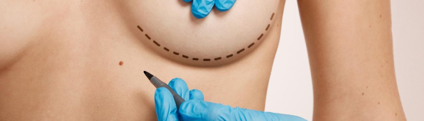 DIEP, la nueva técnica para la reconstrucción mamaria después del cáncer