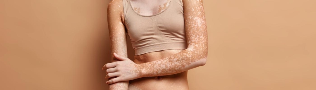 llega-europa-primera-crema-vitiligo