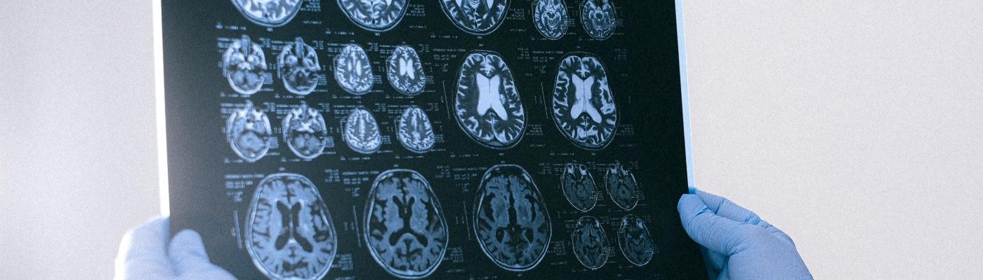 Un estudio advierte de que un fármaco eficaz contra el alzhéimer encoge el cerebro