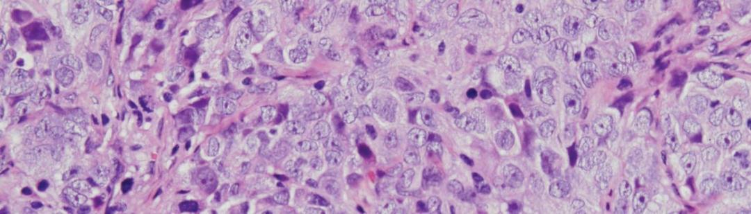 csic-proteina-clave-tratamientos-cancer-ovario