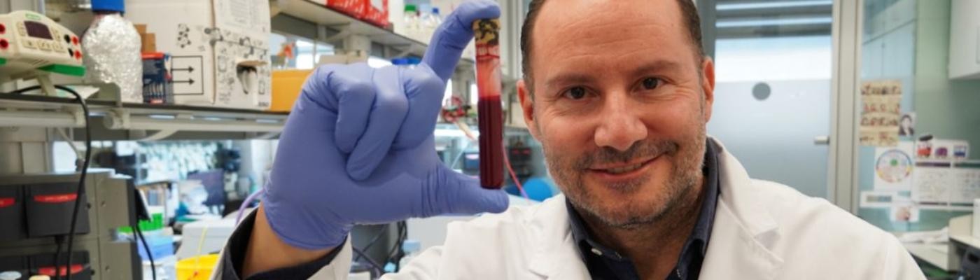 Una nueva biopsia líquida aumenta un 30% la sensibilidad de detección del cáncer de páncreas