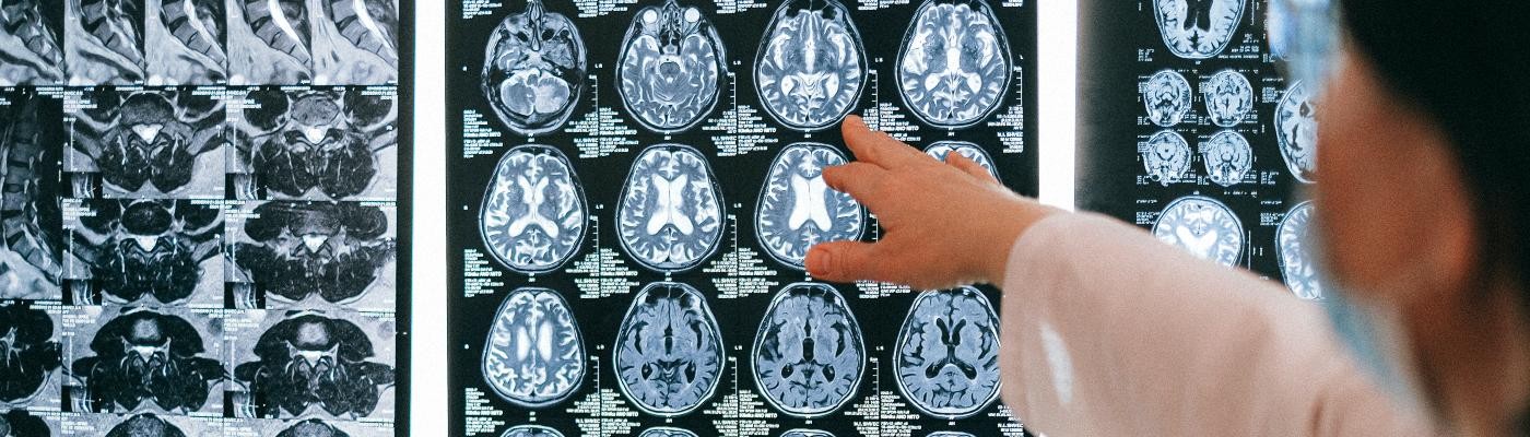Revelan, por primera vez, cómo se propagan las proteínas tóxicas por el cerebro en el alzhéimer