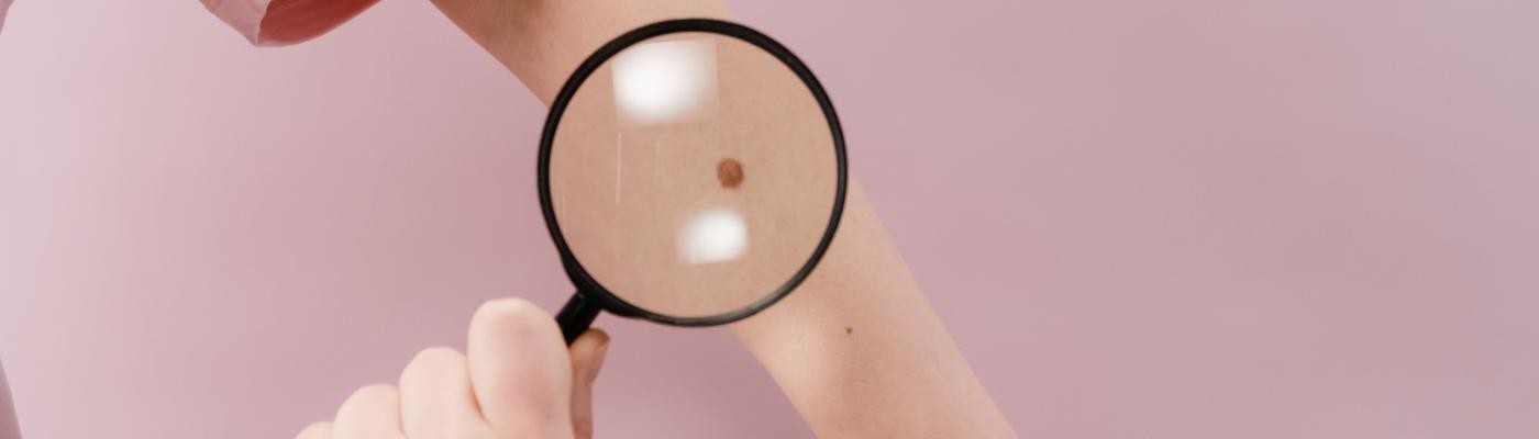 La prevención podría evitar más del 95% de los casos de cáncer de piel