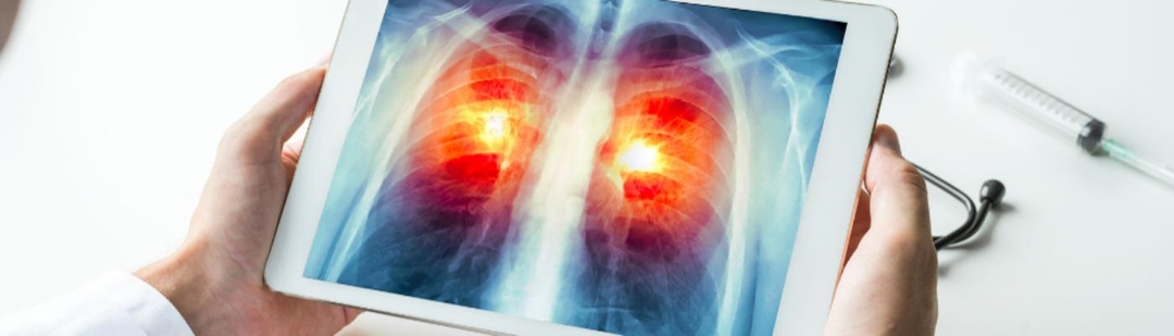 estudio-aumenta-probabilidades-supervivencia-cancer-pulmon