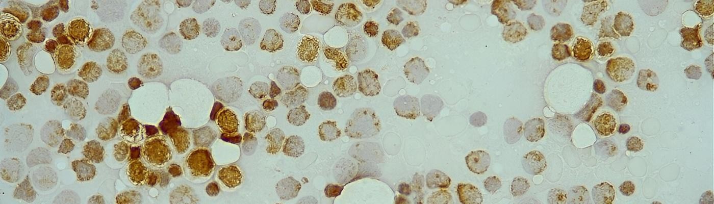 Descubren un biomarcador para casos de leucemia mieloide aguda que no responden al tratamiento