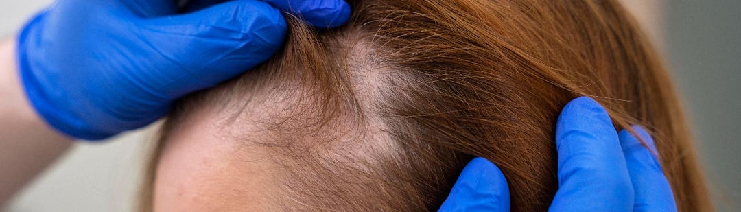 europa-primer-tratamiento-alopecia-adolescentes